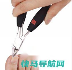 指甲长肉里可以怎么办？ 第4张